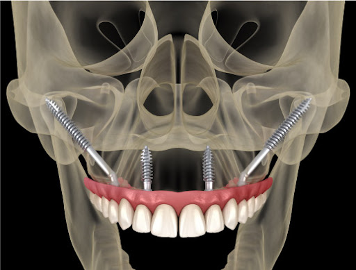 impianto dentale senza osso