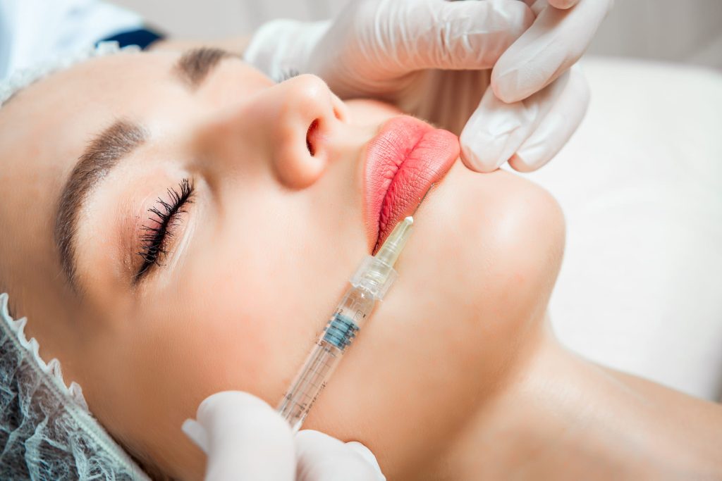 quanto dura il filler alle labbra